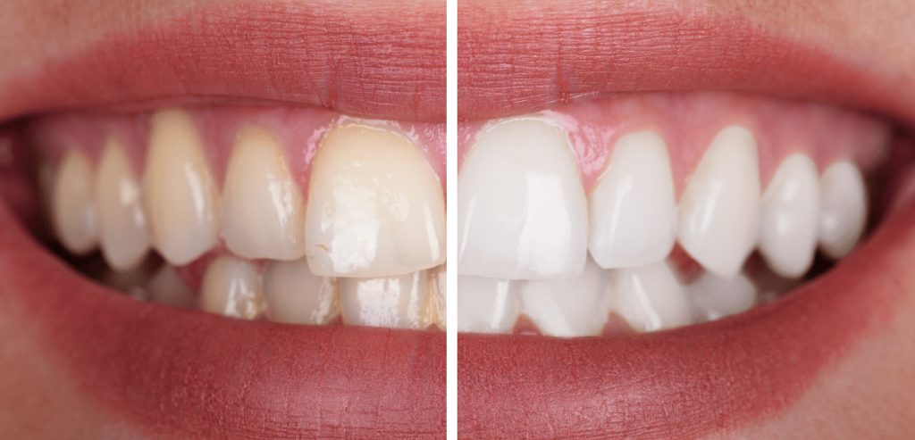 Teeth whitening