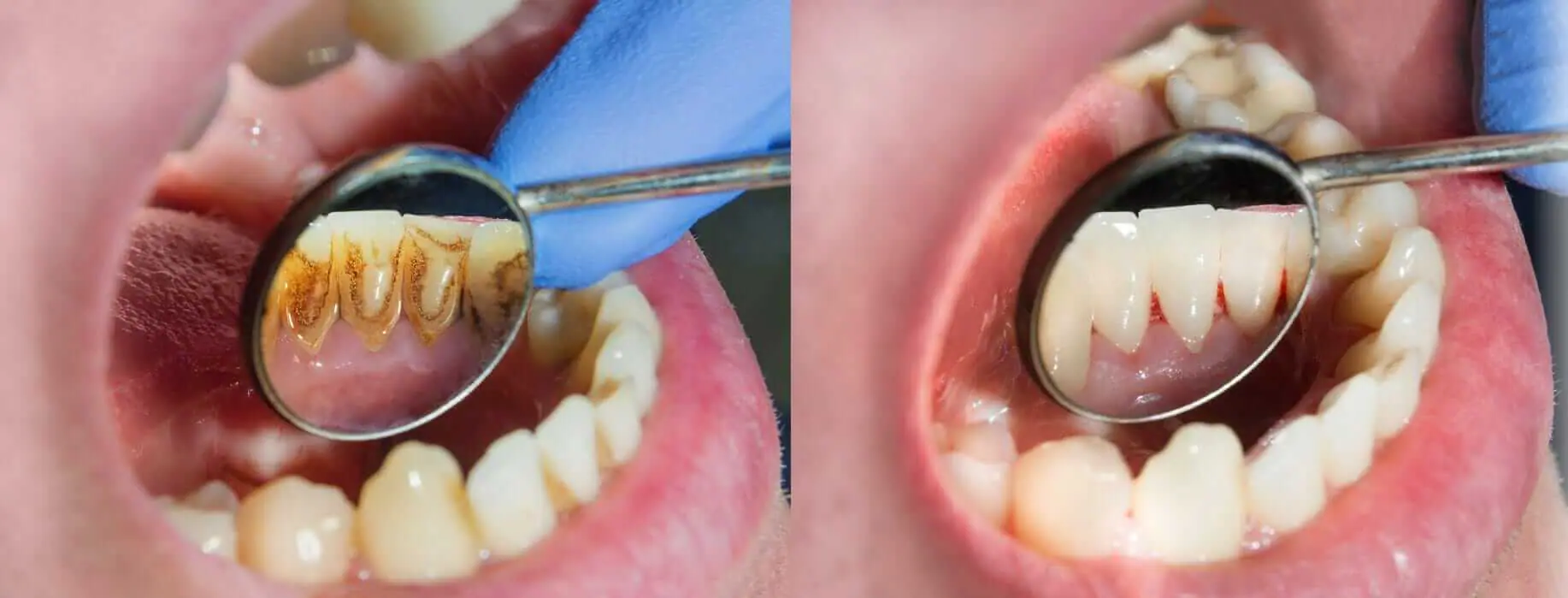 Dental Hygiene