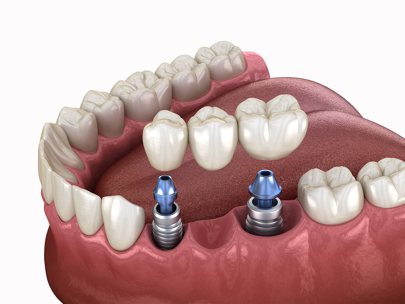Dental implants